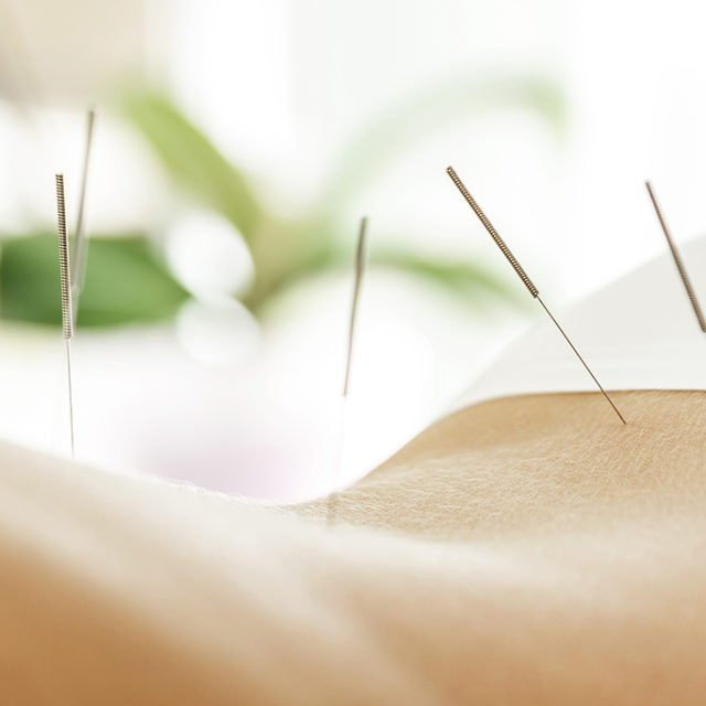 Acupuncture chinoise